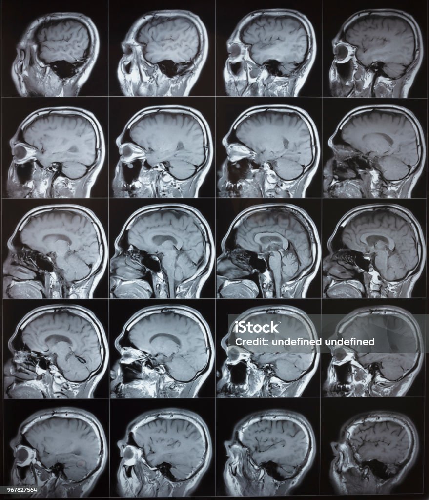 Side View Of Human Normal Brain Mri Stock Photo - Download Image Now
