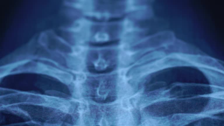 3,107 Osteoporosis Stock Videos and Royalty-Free Footage - iStock | Osteoporosis bone, Bone density, Bone 3,107 Osteoporosis Stock Videos and Royalty-Free Footage - iStock | Osteoporosis bone, Bone density, Bone