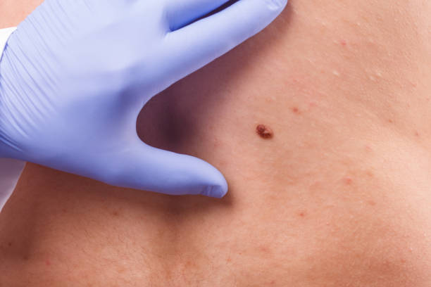 istock the doctor examines the birthmarks on the man's body 968315580