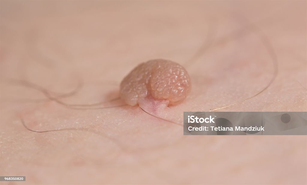 Étiquette de peau pédonculés ou acrochondon ou fibroma molle. Papillome bosse sur le corps masculin coup de macro. Polype Fibroepithelial sur tige. Lésion bénigne épiderme se bouchent. - Photo de Peau libre de droits