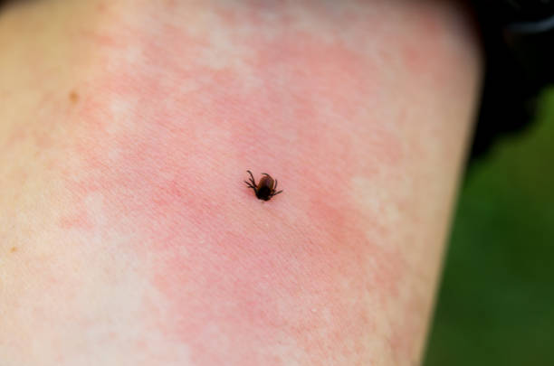 istock Irritation from the bite. Redness on the skin from a tick bite. A dangerous tick bite. 968373034