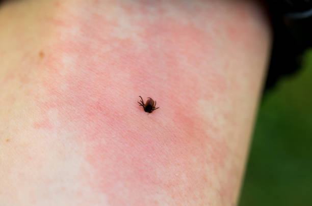 Irritation from the bite. Redness on the skin from a tick bite. A dangerous tick bite. Irritation from the bite. Redness on the skin from a tick bite. A dangerous tick bite. Close-up. castor bean plant photos stock pictures, royalty-free photos & images