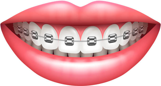 Teeth with braces woman smile isolated on white vector Teeth with braces beautiful woman smile isolated on white vector illustration teeth clipart stock illustrations