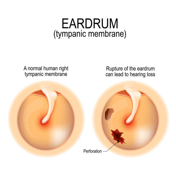 Ruptured (perforated) eardrum Ruptured eardrum. Anatomy of the humans eardrum. Healthy and perforated tympanic membrane. Vector illustration for medical, science, and educational use ear drumm stock illustrations