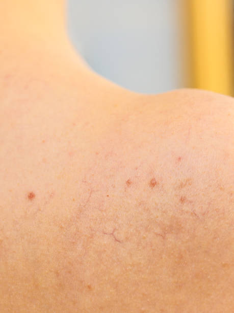 istock Ski with dilated capillaries ad red spots 969139962