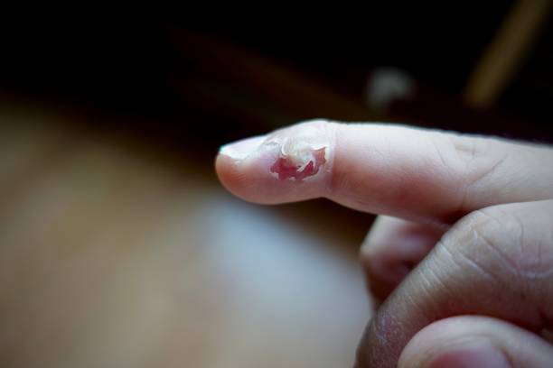 istock treatment wart on finger by salicylic acid 969255908