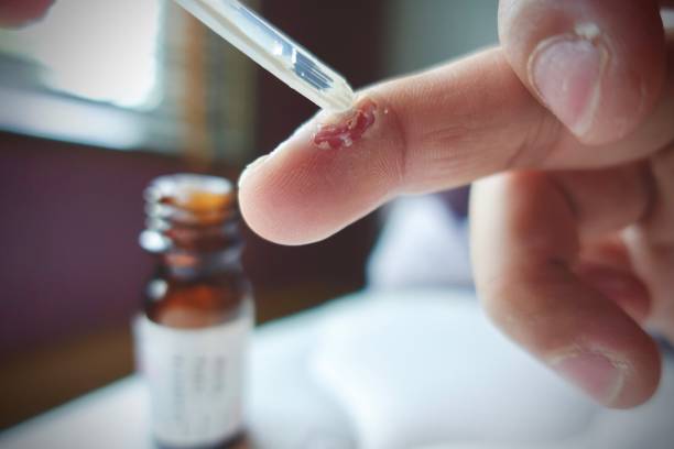 istock treatment wart on finger by salicylic acid 969255968