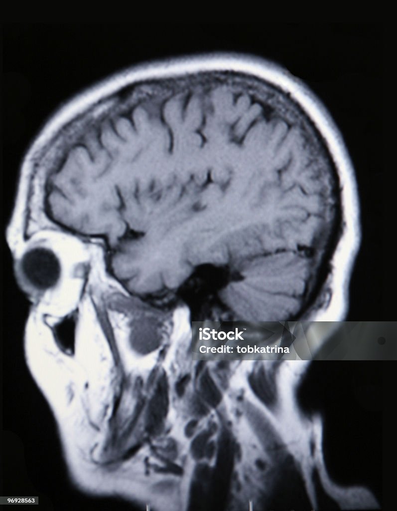 Imagem MRI médico mostrando cérebro e Crânio - Foto de stock de Adulto royalty-free