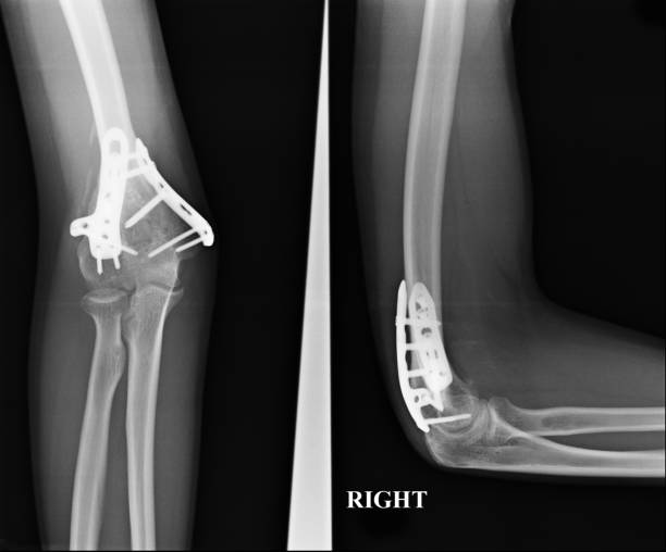 istock Forearm x-rays image showing plate and screw fixation. 969327762