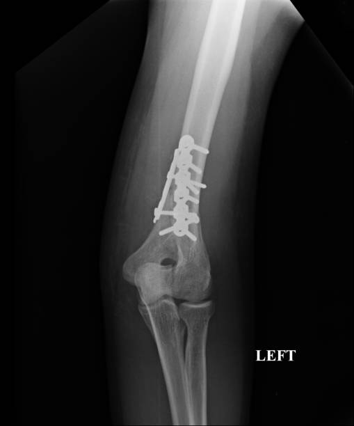 istock Forearm x-rays image showing plate and screw fixation. 969327798