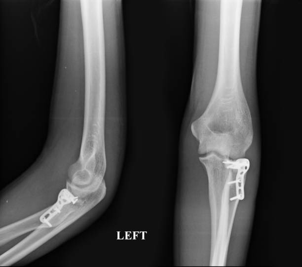 istock Forearm x-rays image showing plate and screw fixation. 969327828