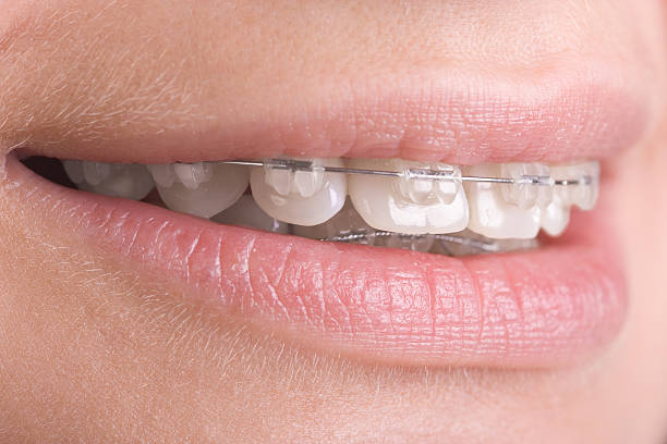 istock A close-up of clear braces on teeth 96934279