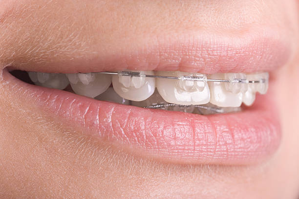 A close-up of clear braces on teeth stock photo