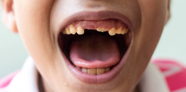 istock Little boy show Broken teeth.boy with a broken and rotten teeth 969633664