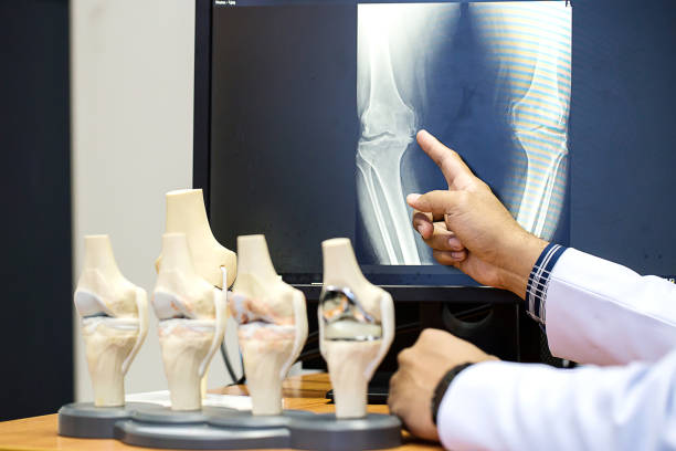 arzt auf den kniepunkt problem auf röntgenfilm zeigt. röntgenfilm skelett knie auf film anzeigen chirurgie-medizintechnik-konzept. arthrose bei älteren menschen. - osteoporose stock-fotos und bilder
