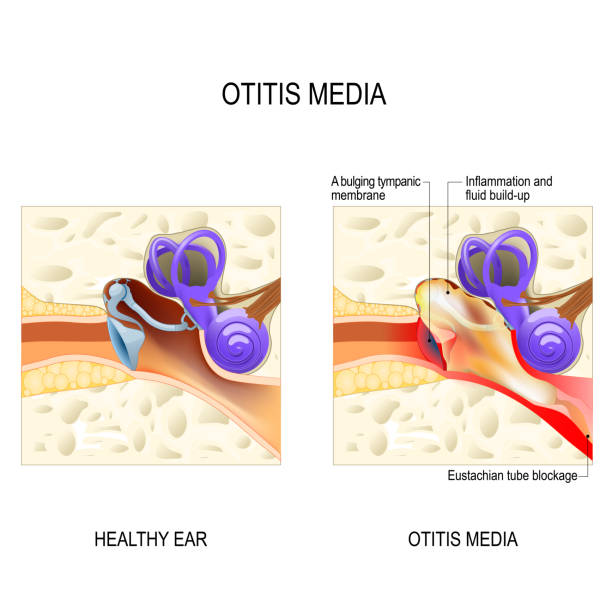 ilustrações de stock, clip art, desenhos animados e ícones de otitis media. human anatomy. - eustachian tube