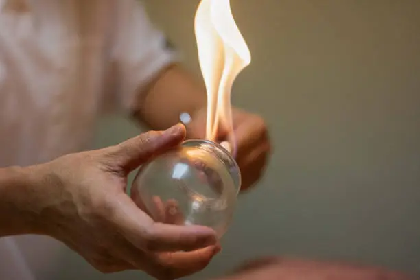 An open flame is used to extinguish the oxygen inside of special glass cups which creates a temporary suction. The cup is then quickly placed on the appropriate area of the person receiving cupping treatment, usually along the back or neck, where the suction holds the cup in place. Cupping is an effective form of pain relief treatment used commonly in Traditional Chinese Medicine (TCM) along with acupuncture.