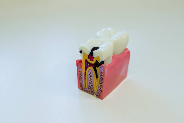 istock Tooth model for education in laboratory isolated. caries, tooth decay, dental decay. Problems with teeth. Copy space 970004168