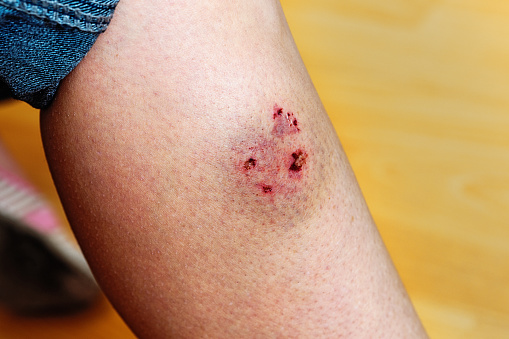 Woman's leg injured by a dog bite