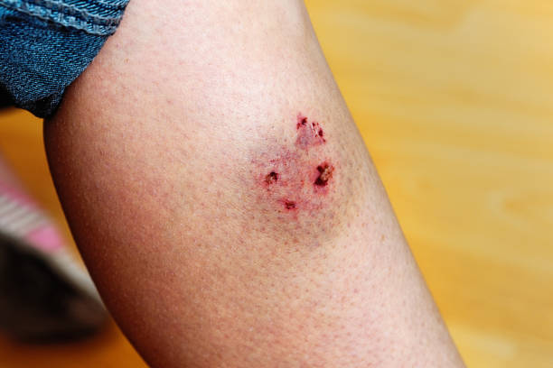 Dog bite leaves puncture marks and bruise on woman's leg stock photo
