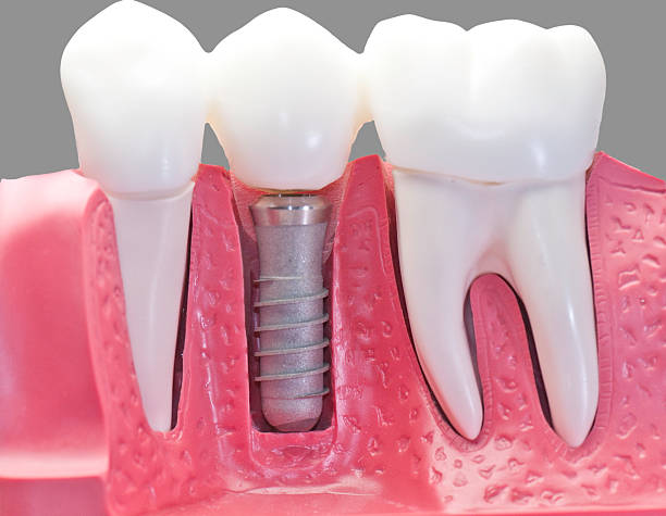 istock Capped dental Implant Model 97031220