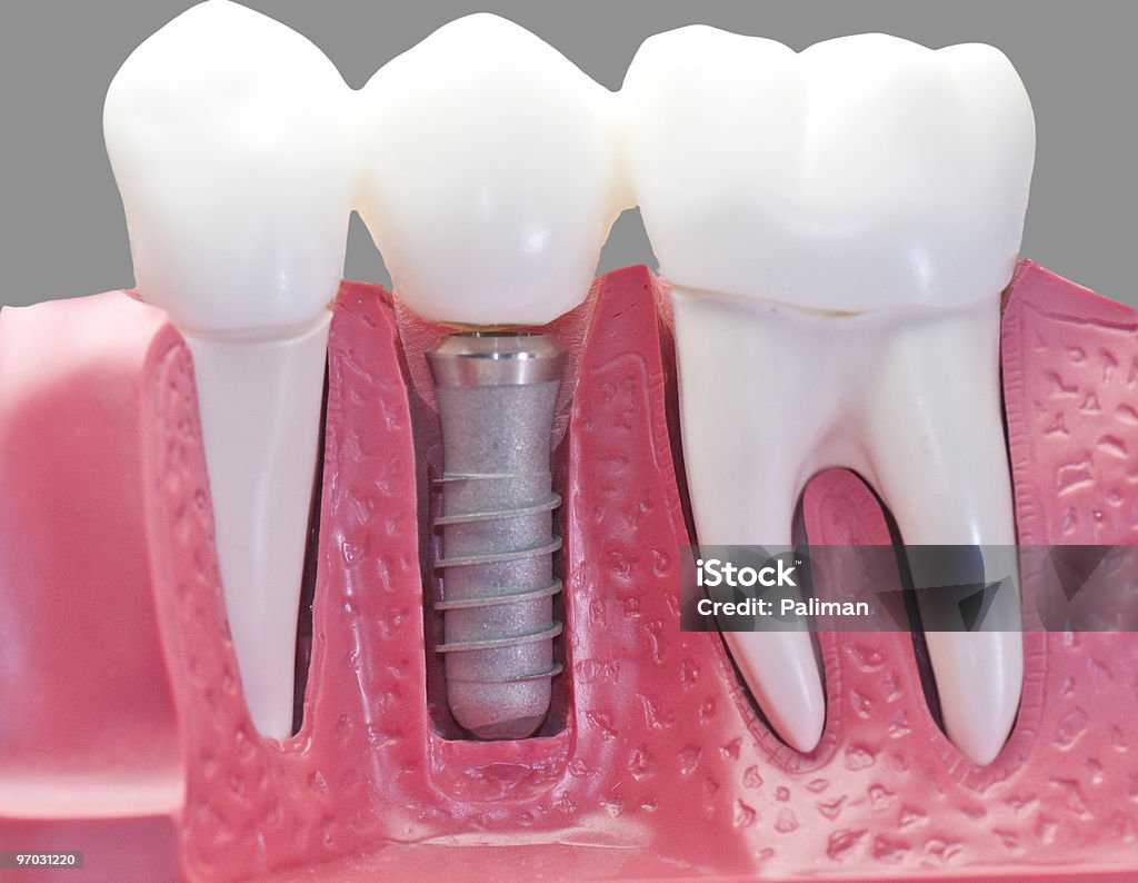 Capped dental Implant Model  Arranging Stock Photo