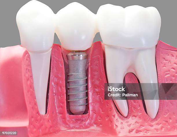 Capped Dental Implant Model Stock Photo - Download Image Now - Arranging, Artificial, Close-up