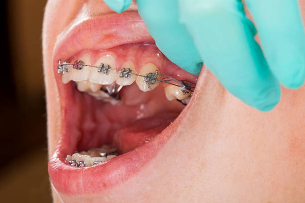 istock Boy with braces. Dental check up 970639394