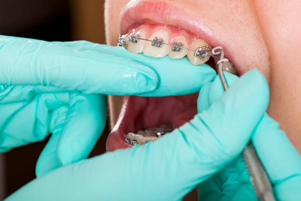 istock Boy with braces. Dental check up 970639418