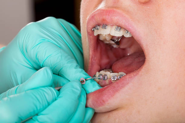 istock Boy with braces. Dental check up 970643876