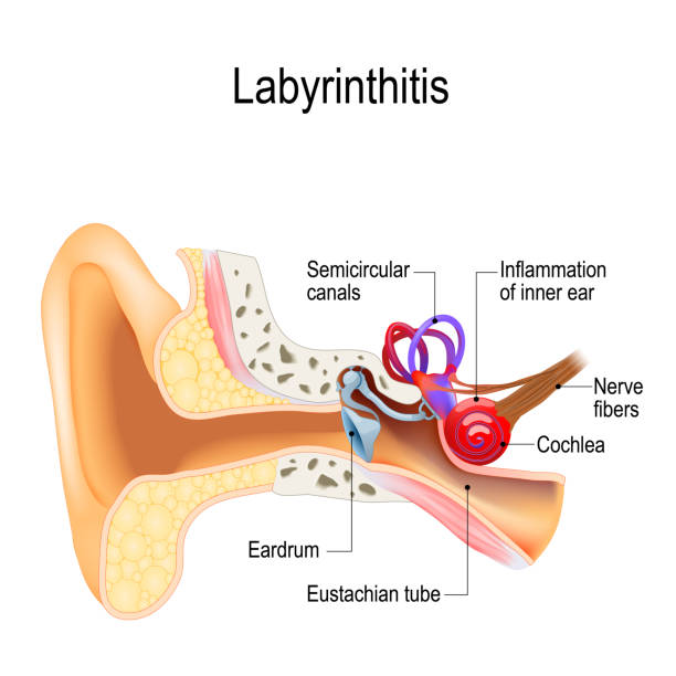 labyrinthitis (vestibular 신경 염)은 내가 염증. - eustachian tube stock illustrations