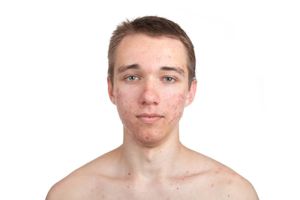 Handsome young man with skin problem Handsome young man with skin problem on white background chest torso photos stock pictures, royalty-free photos & images