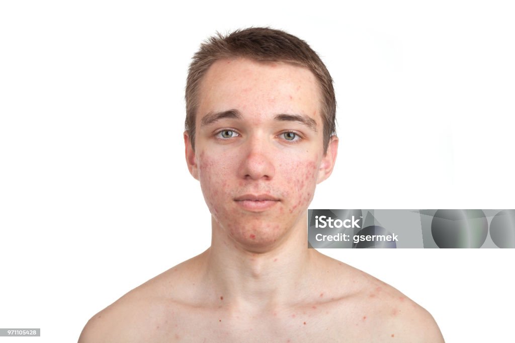 Jovem bonito com problema de pele - Foto de stock de Acne royalty-free