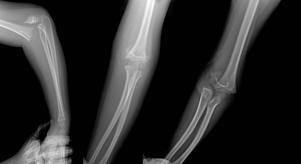 raio-x do braço quebrado - bending human foot ankle x ray image - fotografias e filmes do acervo