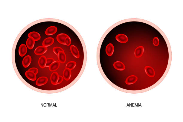 Anemia. blood of healthy human and blood vessel with anemia. blood of healthy human and blood vessel with anemia (difference). Anemia is a decrease in the total amount of red blood cells or hemoglobin in the blood. Vector illustration. anemia diagram stock illustrations