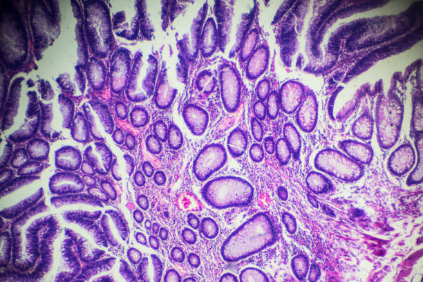 intestinale adenomatose menschliche pathologische muster unter mikroskop - wissenschaftliche mikroskopische aufnahme stock-fotos und bilder