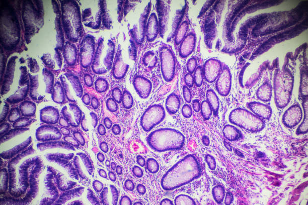 кишечный аденоматоз человека патологический образец под микроскопом - scientific micrograph стоковые фото и изображения