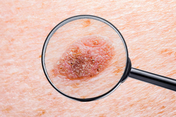 Skin Mole Defect High Magnification for Medical Diagnosis stock photo