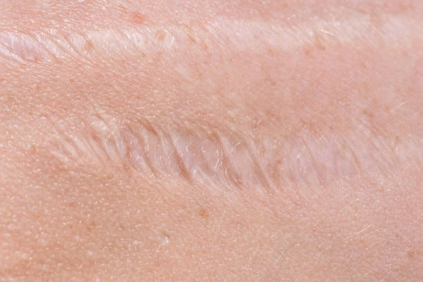 scar on the skin Scar on the skin. Human scar close-up scarification stock pictures, royalty-free photos & images
