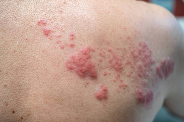 Shingles (Disease), Herpes zoster, varicella-zoster virus. skin rash and blisters stock photo
