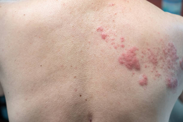 Shingles (Disease), Herpes zoster, varicella-zoster virus. skin rash and blisters Shingles (Disease), Herpes zoster, varicella-zoster virus. skin rash and blisters on body shingles rash stock pictures, royalty-free photos & images