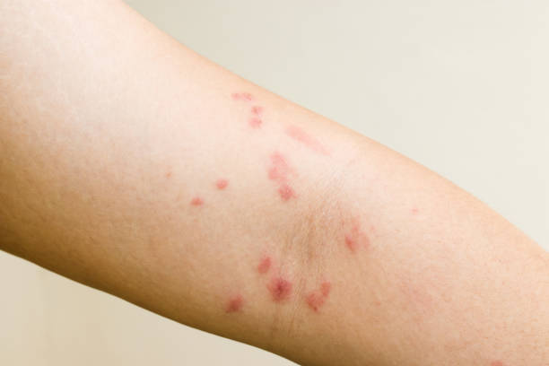 istock woman has skin rash itch. Health problem concept. 972672264