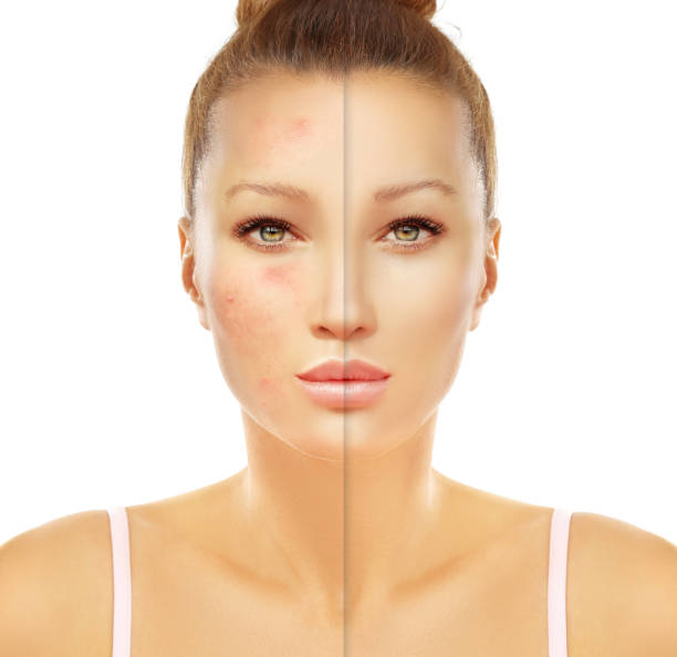 istock Post-Acne Marks,Acne Scars,rosacea 972688686