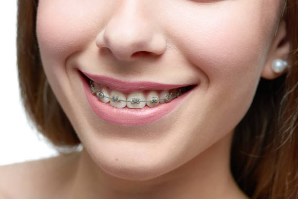 istock Studio close up of model's beatiful smile with teethbraces. 973096566