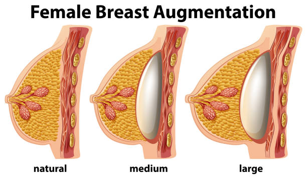 A Set of Female Breast Augmentation A Set of Female Breast Augmentation illustration silicone implants stock illustrations