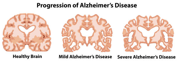 ilustraciones, imágenes clip art, dibujos animados e iconos de stock de una anatomía del cerebro humano - alzheimer