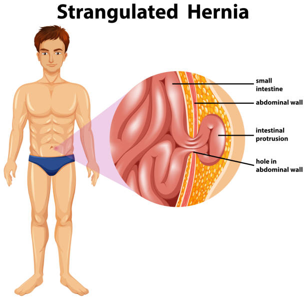 Human Anatomy of Strangulated Hernia Human Anatomy of Strangulated Hernia illustration abdominal cavity stock illustrations