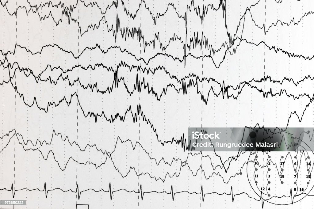 Eeg Patterns Brain Wave Patterns On Electroencephalogram Eeg Of The Pediatric ...