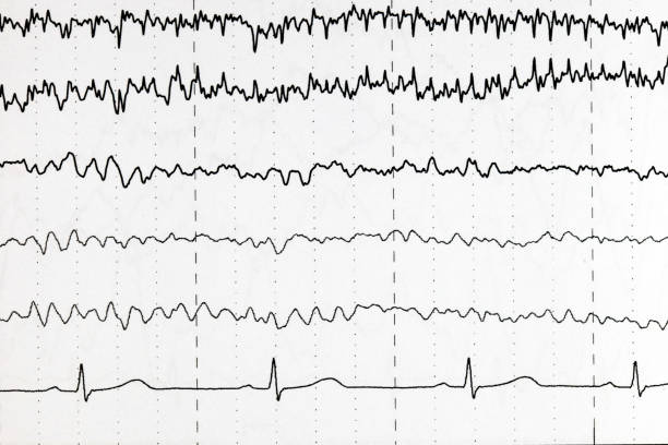 istock Brain wave patterns on electroencephalogram, EEG of the pediatric patients, problems in the electrical activity of the brain. 973857172