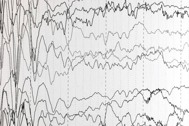 brain wave patterns on electroencephalogram, eeg of the pediatric patients, problems in the electrical activity of the brain. - eeg epilepsy science electrode imagens e fotografias de stock